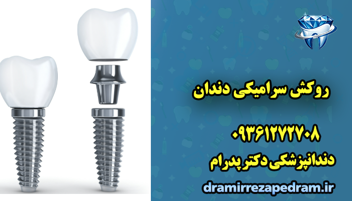 ایمپلنت کره ای