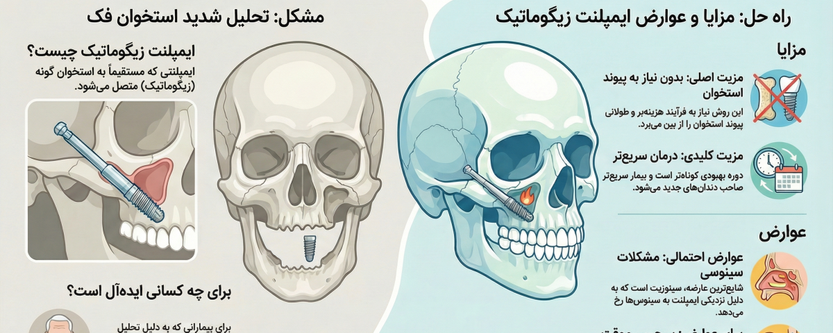 ایمپلنت زیگوماتیک: راه حل نوین