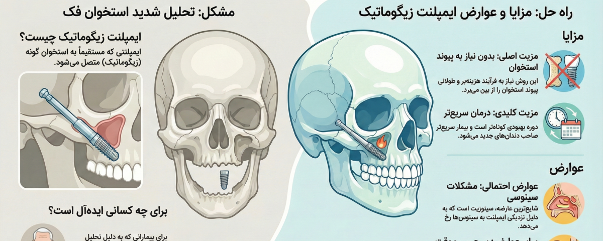ایمپلنت زیگوماتیک: راه حل نوین