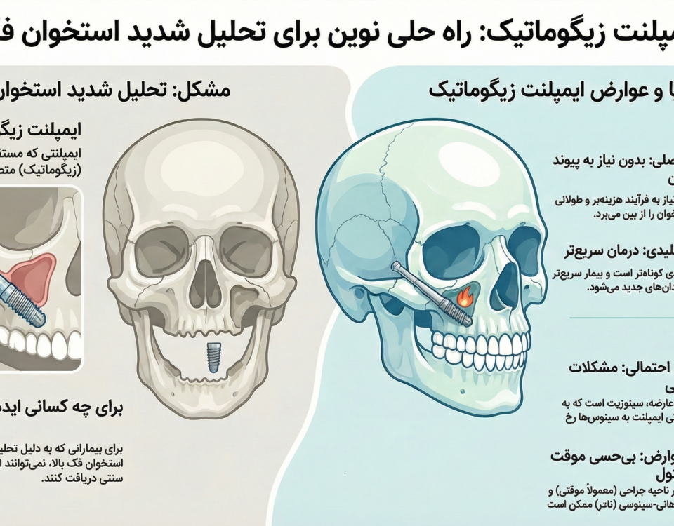 ایمپلنت زیگوماتیک: راه حل نوین