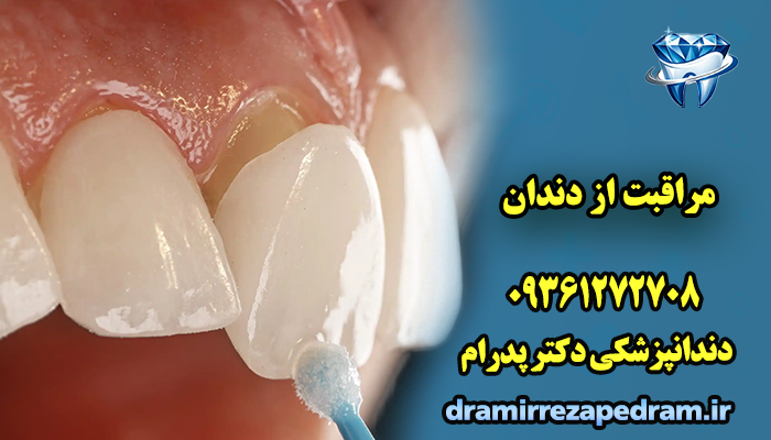 مراقبت از دندان