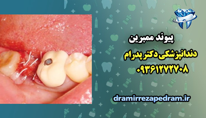 پیوند ممبرین