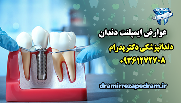 عوارض ایمپلنت دندان