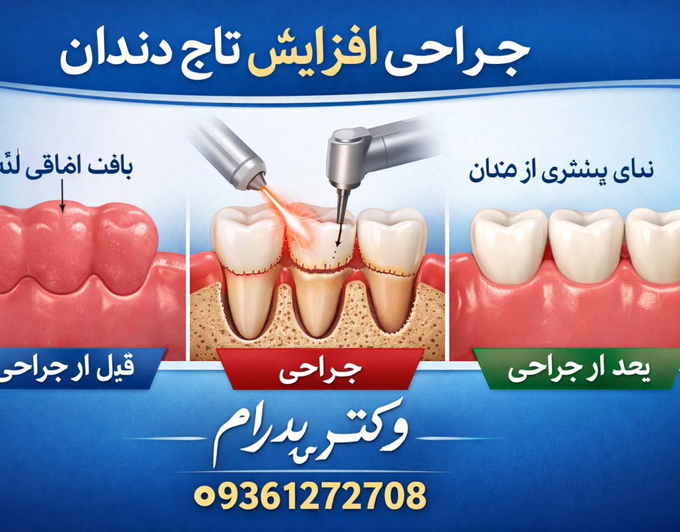 جراحی افزایش طول تاج دندان