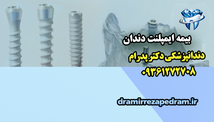 بیمه ایمپلنت دندان