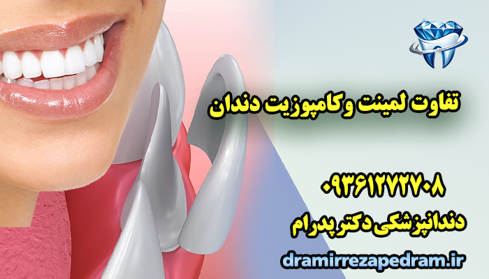 تفاوت لمینت وکامپوزیت دندان