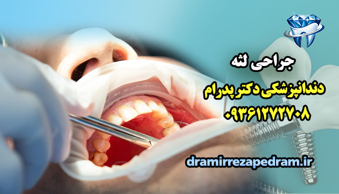 جراحی لثه 2 جراحی لثه