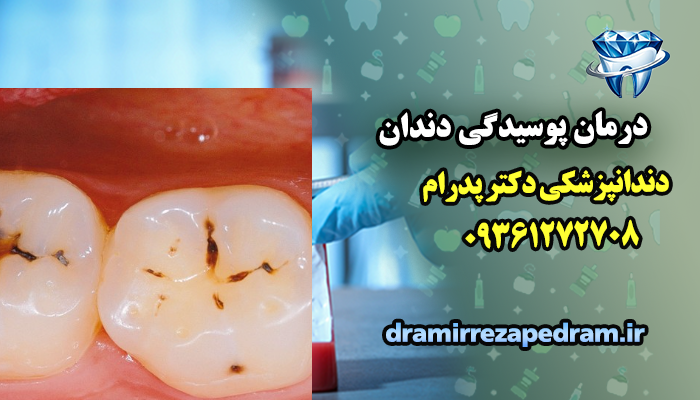 درمان پوسیدگی دندان