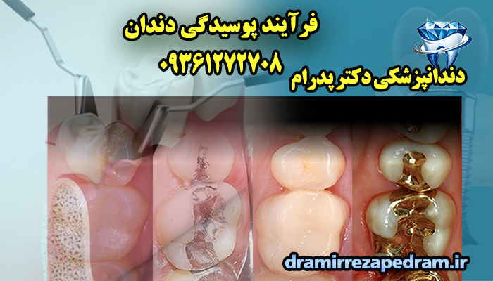 فرآیند پوسیدگی دندان