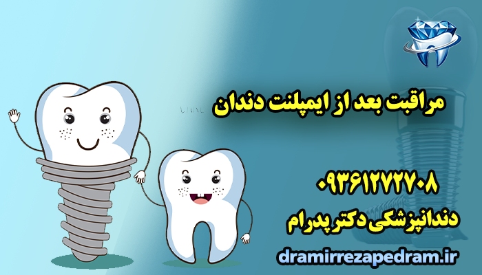 مراقبت بعد از ایمپلنت دندان