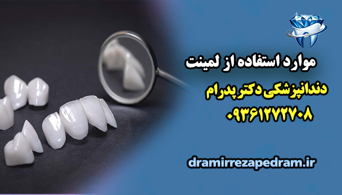 موارد استفاده از لمینت سرامیکی