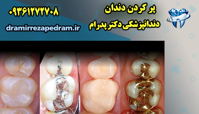پر کردن دندان 2 پر کردن دندان