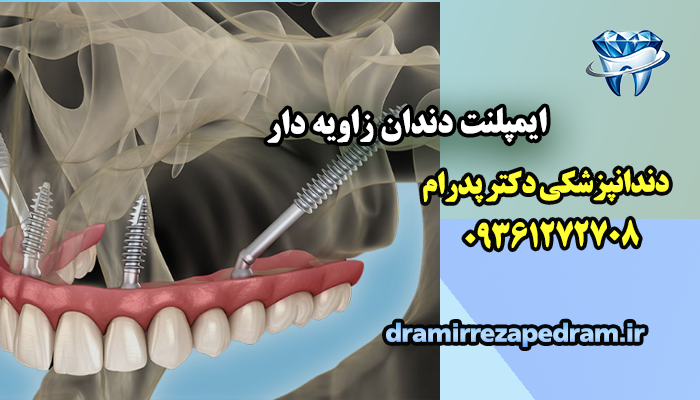 ایمپلنت دندان زاویه دار