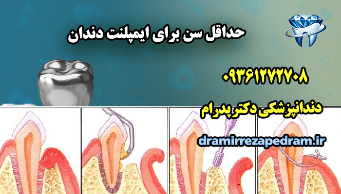 حداقل سن برای ایمپلنت دندان 2 حداقل سن برای ایمپلنت دندان