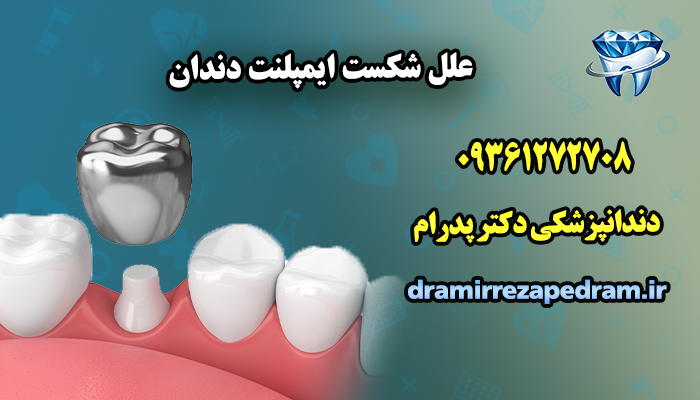 علل شکست ایمپلنت دندان