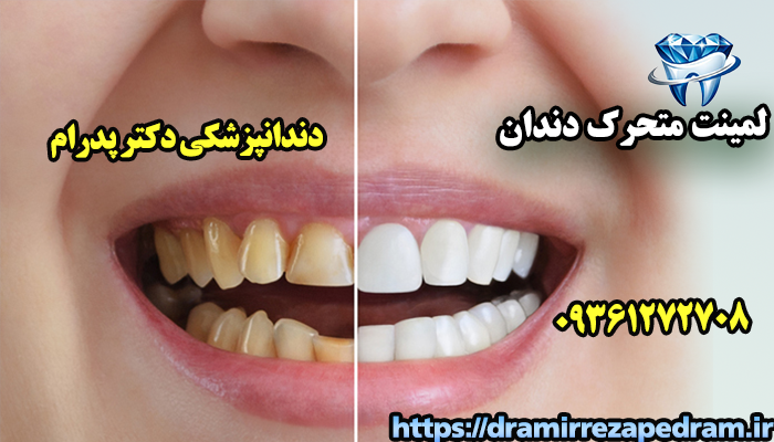 لمینت متحرک دندان