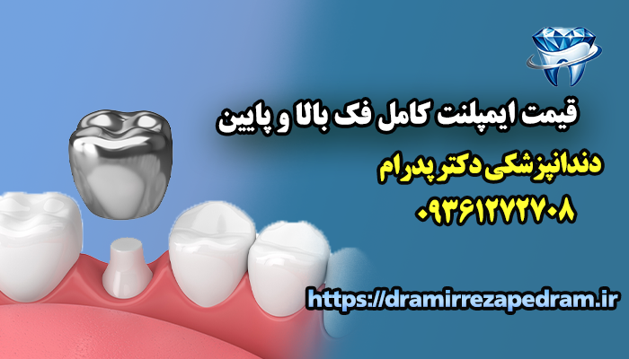 قیمت ایمپلنت کامل فک بالا و پایین