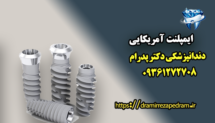 ایمپلنت آمریکایی