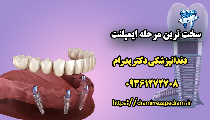 سخت ترین مرحله ایمپلنت