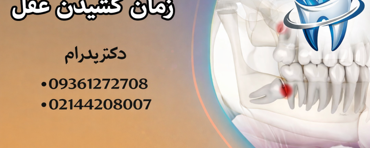 زمان کشیدن دندان عقل