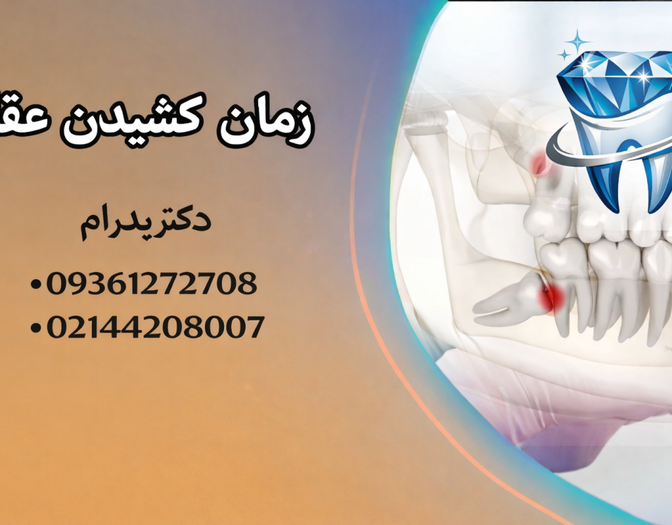 زمان کشیدن دندان عقل