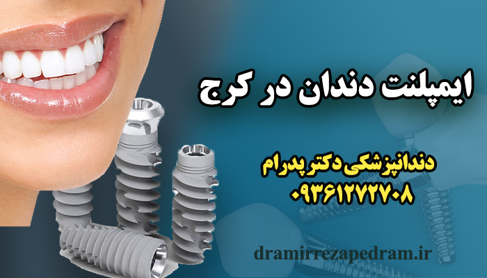 ایمپلنت دندان در کرج