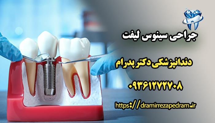 جراحی سینوس لیفت