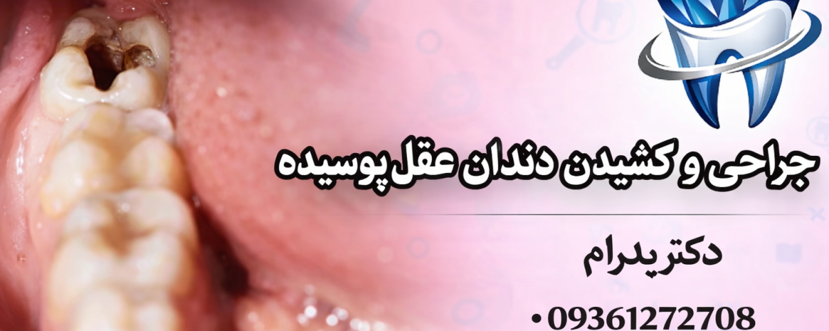 جراحی و کشیدن دندان عقل پوسیده