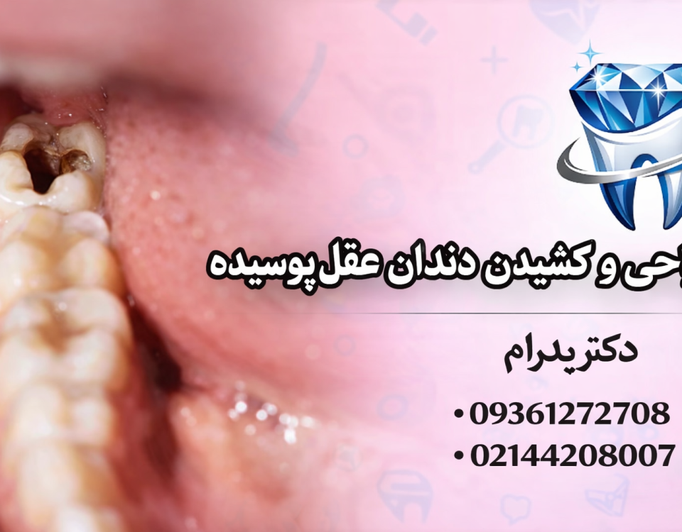 جراحی و کشیدن دندان عقل پوسیده