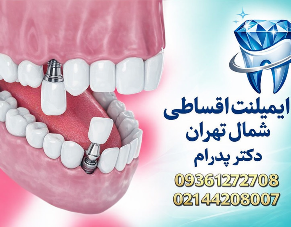 ایمپلنت اقساطی در شمال تهران