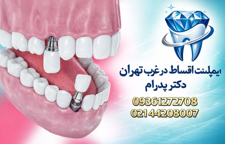 ایمپلنت اقساطی در غرب تهران