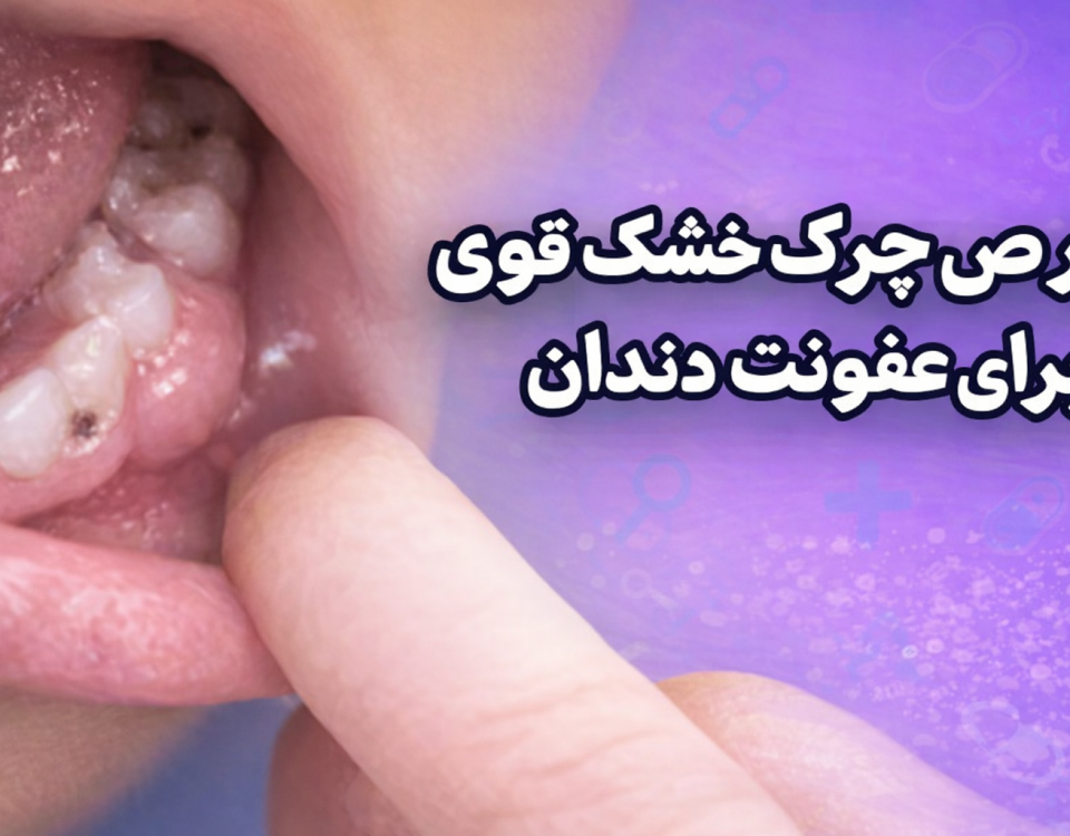 قرص چرک خشک کن قوی برای عفونت دندان