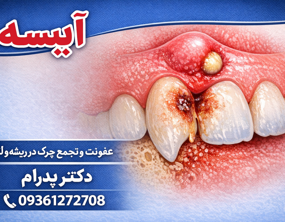 آبسه دندان
