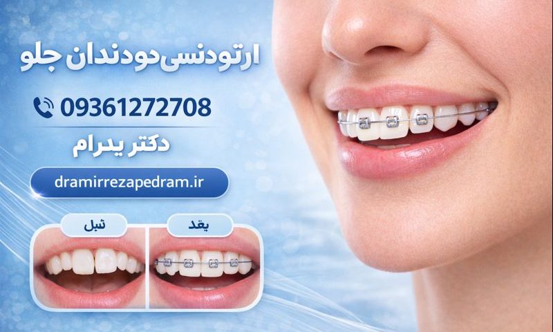 ارتودنسی دو دندان جلو