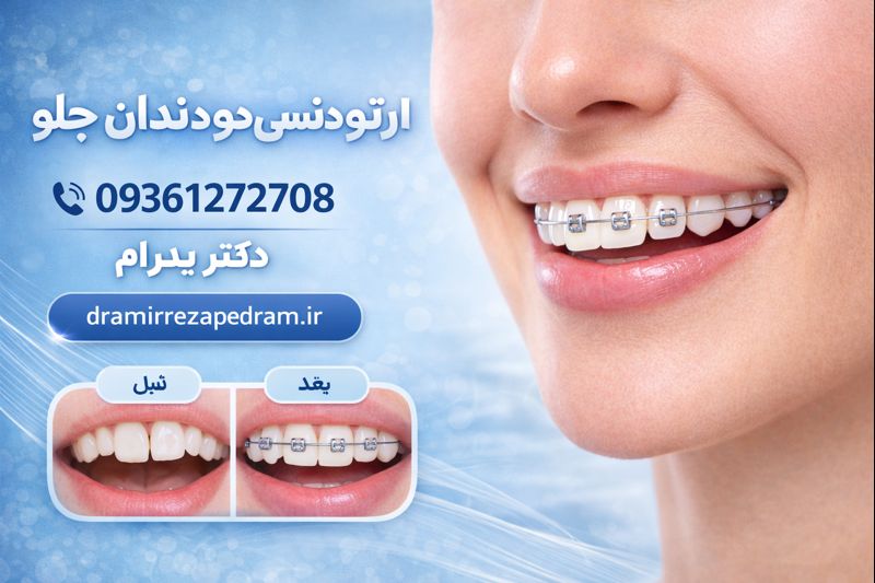 ارتودنسی دو دندان جلو