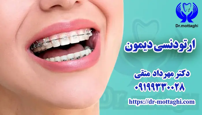ارتودنسی دیمون