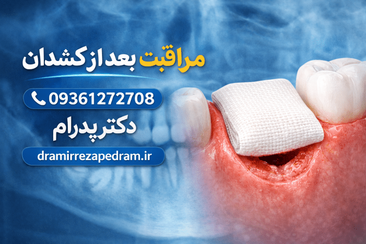 مراقبت بعد از کشیدن دندان