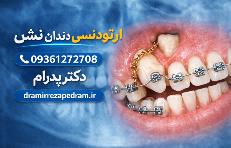 ارتودنسی دندان نیش نهفته 2 ارتودنسی دندان نیش نهفته