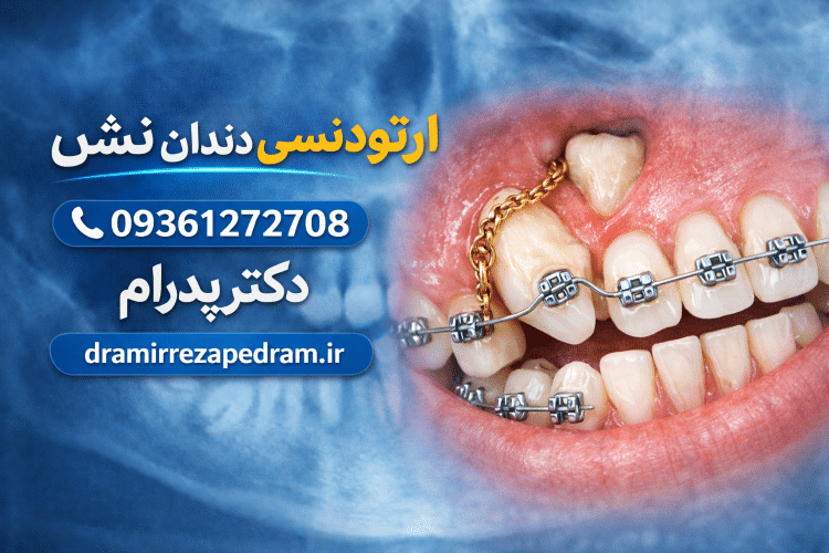 ارتودنسی دندان نیش نهفته