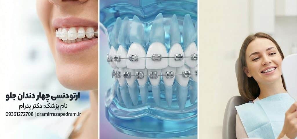 ارتودنسی چهار دندان جلو