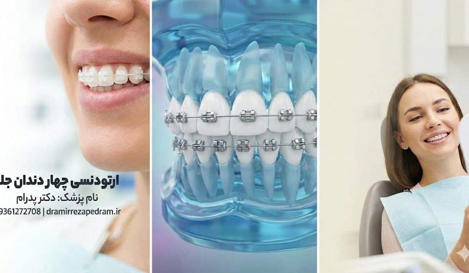 ارتودنسی چهار دندان جلو