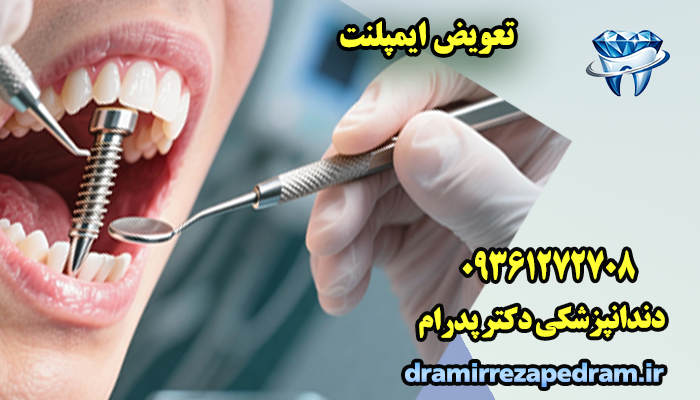 تعویض ایمپلنت