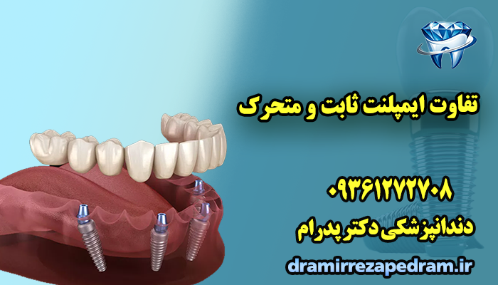 تفاوت ایمپلنت ثابت و متحرک