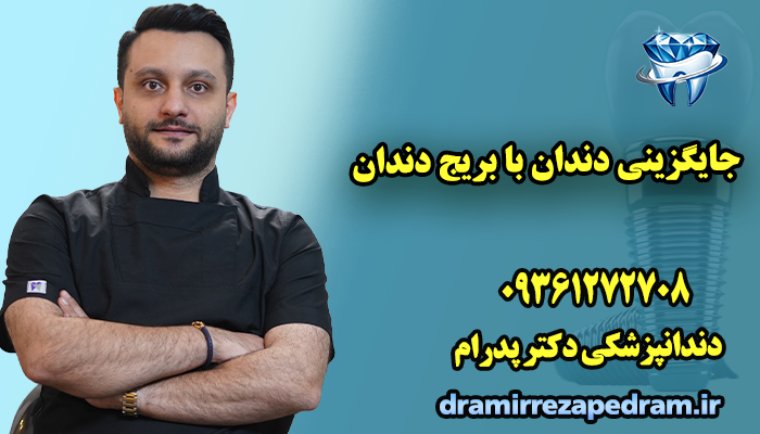 جایگزینی دندان با بریج دندان