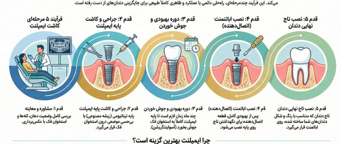 مراحل ایمپلنت دندان