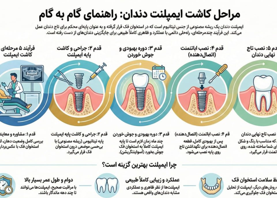 مراحل ایمپلنت دندان