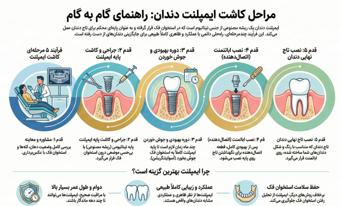مراحل ایمپلنت دندان