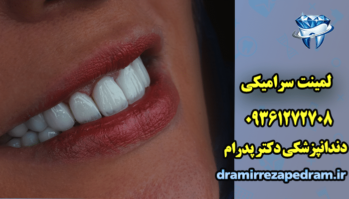 لمینت سرامیکی 2 لمینت سرامیکی