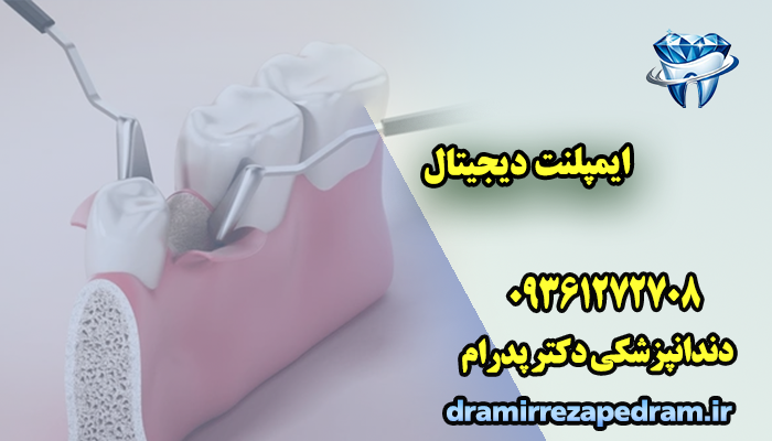 قیمت ایمپلنت دیجیتال 3 ایمپلنت دیجیتال