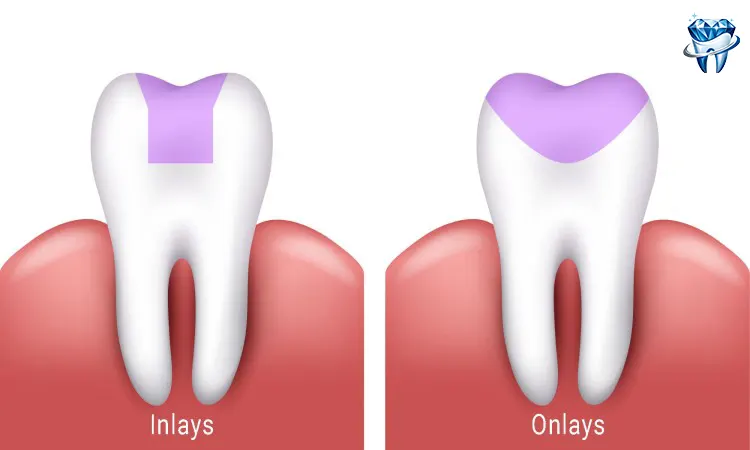 اینله و آنله دندان چگونه کار میکنند؟ 3 اینله و آنله دندان چگونه کار میکنند؟